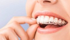 Invisalign: L’ortodòncia del futur