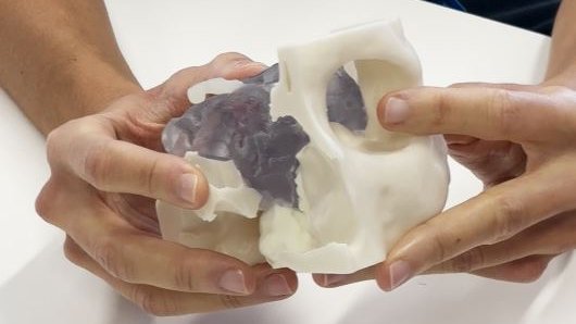 El Parc Taulí extirpa amb èxit, per primer cop, un tumor cerebral a través de l’ull